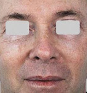 After — Skin resurfacing