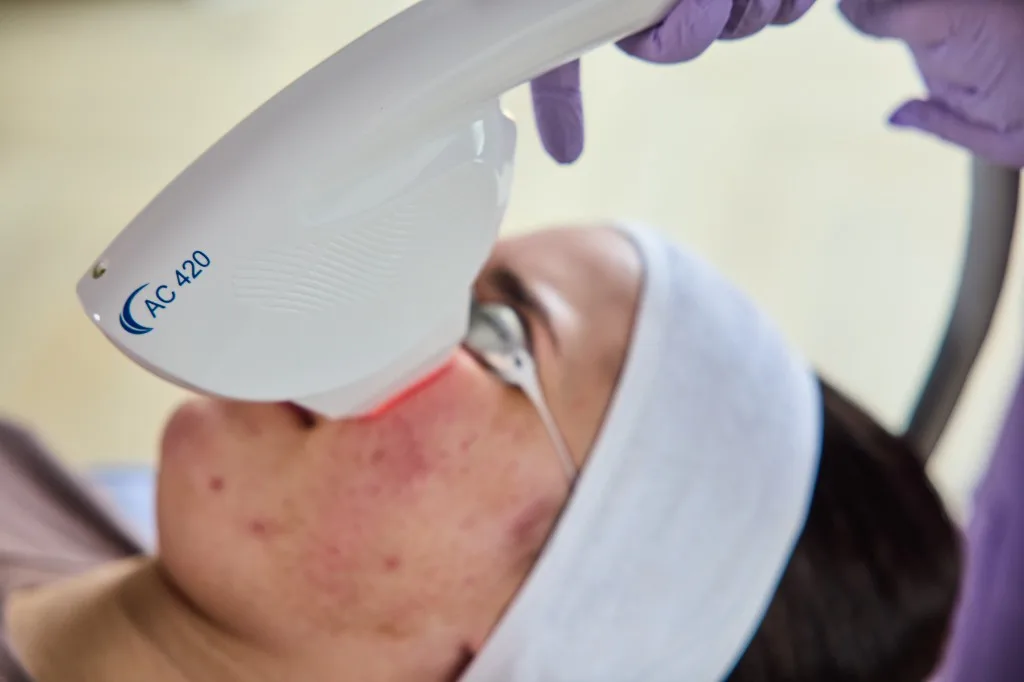 Close-up of AC 420 handpiece delivering 420nm treatment to inflamed acne on the cheek