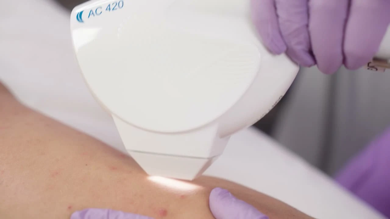 Close-up of the AC 420 handpiece CoolTip™ sapphire tip in contact with the skin
