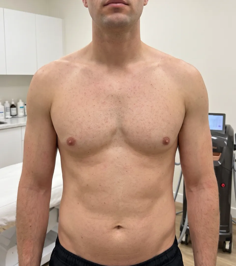 Après — Chest hair reduction
