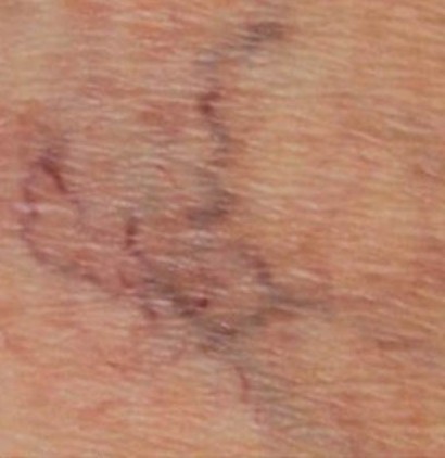 Vein Removal Before