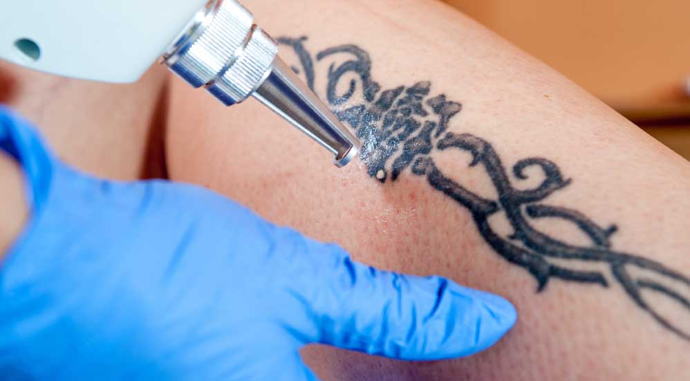 Top 5 Reasons People Get Tattoos Removed
